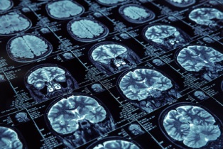 systems-medicine- eMed - brain